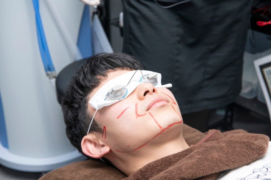 ヒゲ脱毛の施術　レーザーを照射する間はアイマスクを着用する