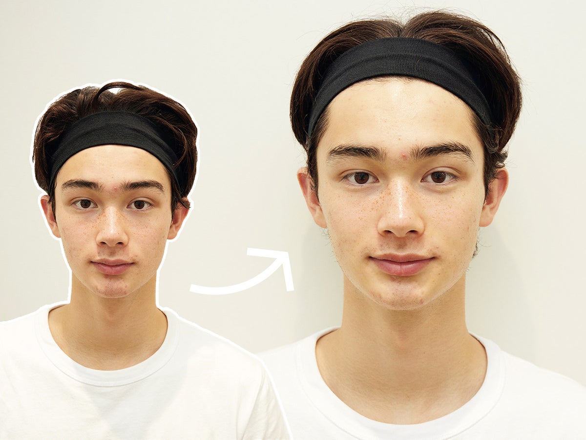 【ニキビ対策】モデル栄莉弥が美容クリニックへ行ってきた！実際どんな施術なのか？体験レポート