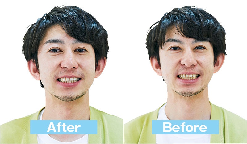 ホワイトニング　BEFORE AFTER