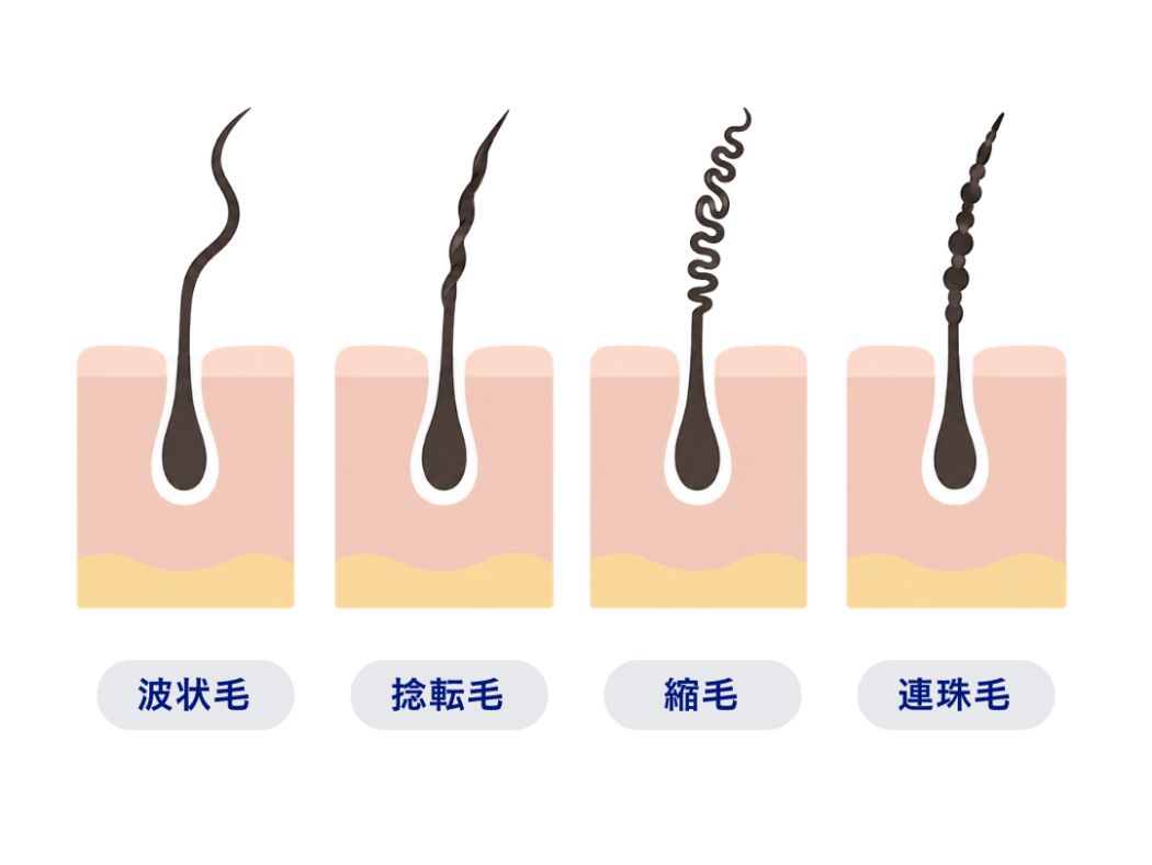 くせ毛の種類